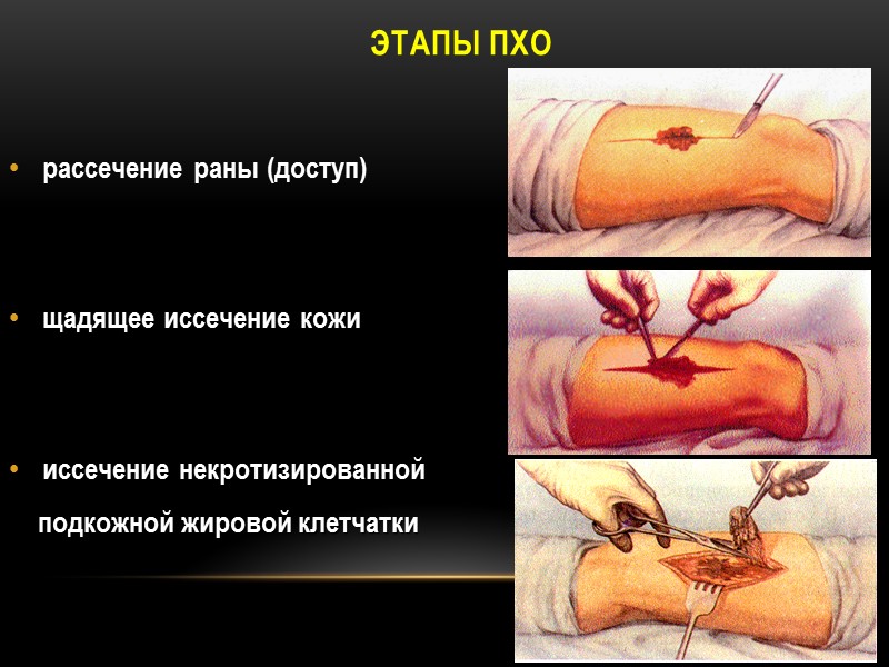 Этапы ПХО   рассечение раны (доступ)   щадящее иссечение кожи  